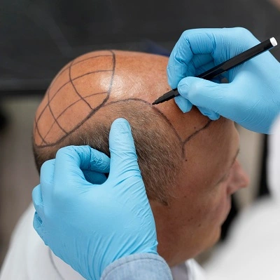 What to Know Before Visiting a Hair Transplant Clinic in Dubai: Expert Insights and Practical Tips